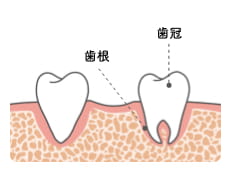 インプラント治療