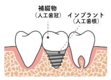 インプラント治療