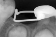 クラウンループ