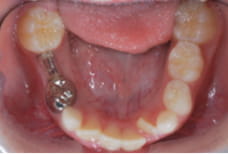 ディスタルシュー