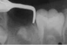 ディスタルシュー