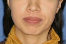 MFT前(32歳)