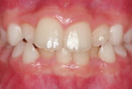 小児矯正できれいな歯ならびに