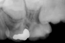 異所萌出の治療例