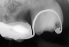 異所萌出の治療例