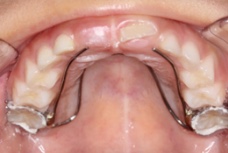 ファーレル拡大装置 / コフィン拡大装置